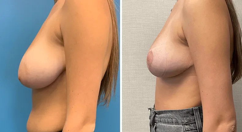 Before and after breast reduction: patient's breasts in left profile