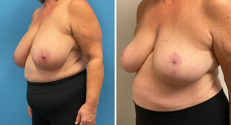Before and after breast reduction: patient's breasts from the left side