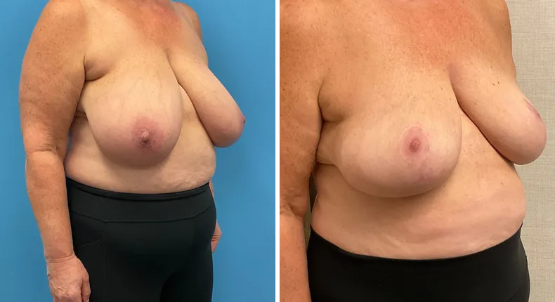 Before and after breast reduction: patient's breasts from the right side