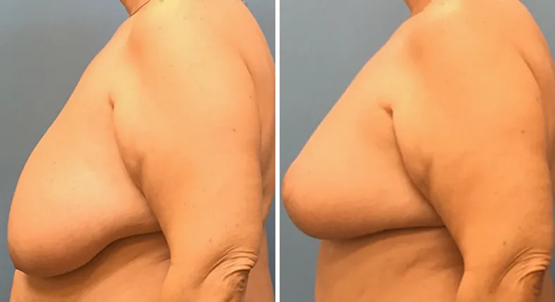 Before and after breast reduction: woman's breasts from the left side