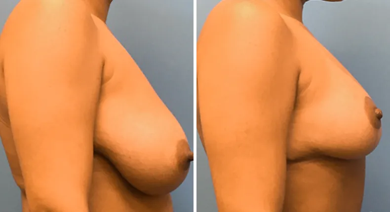 Before and after breast reduction: patient's breasts from the right side