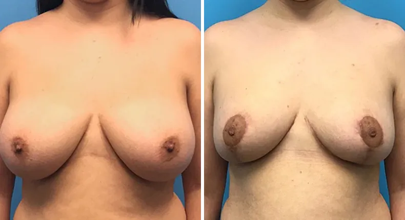 Before and after breast reduction: patient's breasts from the front