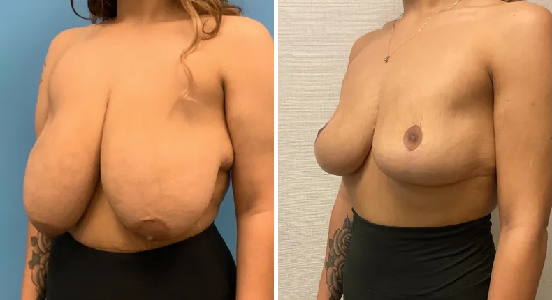 Before and after breast reduction: woman's breasts at a left angle