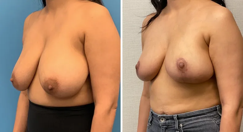 Before and after breast reduction: woman's breasts at a left angle