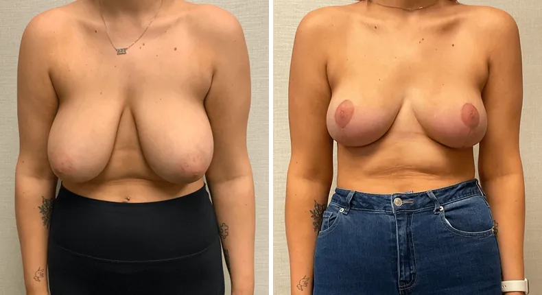 Before and after breast reduction: patient's breasts from the front