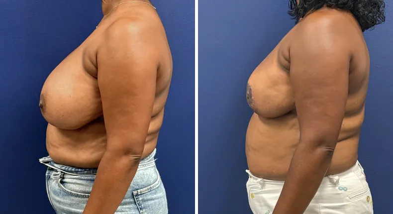 Before and after breast reduction: patient's breasts from the left side