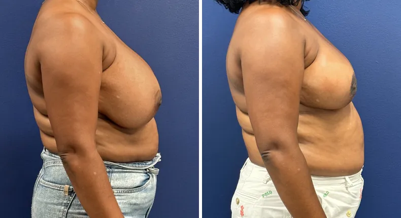 Before and after breast reduction: patient's breasts from the right side