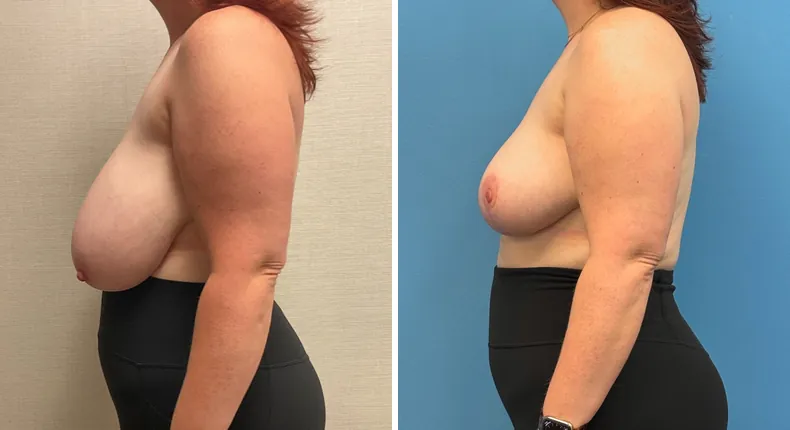 Before and after breast reduction: patient's breasts from the left side