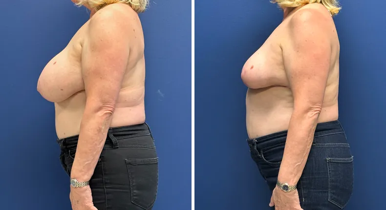 Before and after breast reduction: patient's breasts from the left side