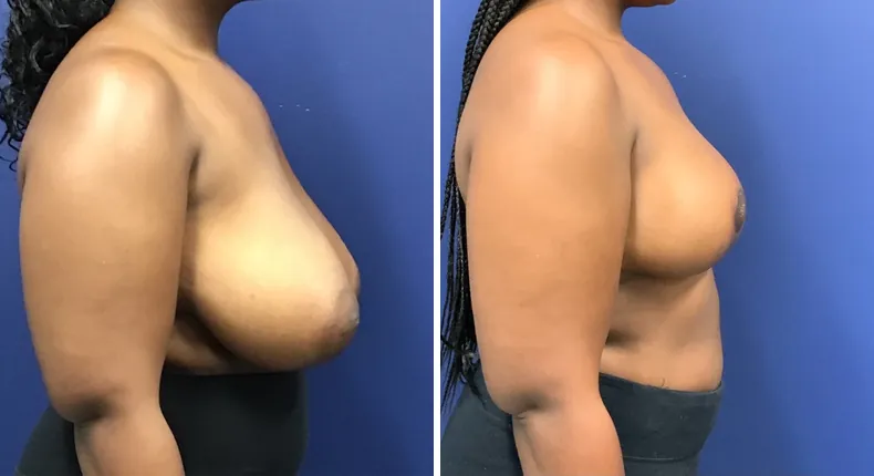 Before and after breast reduction: patient's breasts from the right side