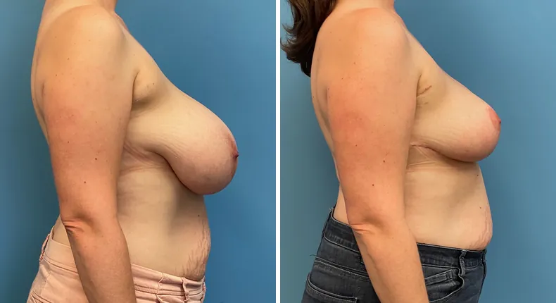 Before and after breast reduction: patient's breasts from the right side
