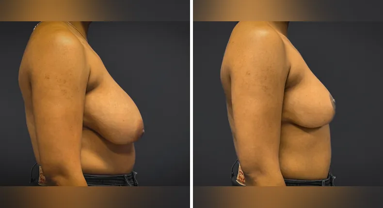 Before and after breast reduction: patient's breasts