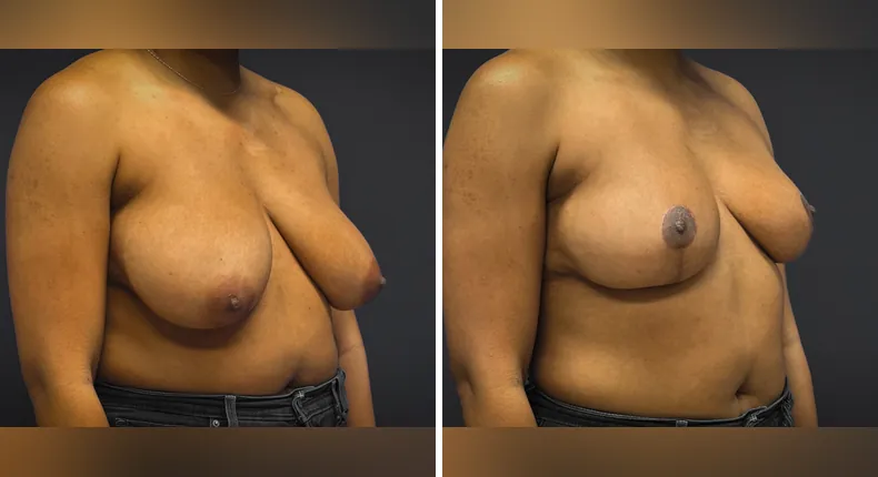 Before and after breast reduction: patient's breasts
