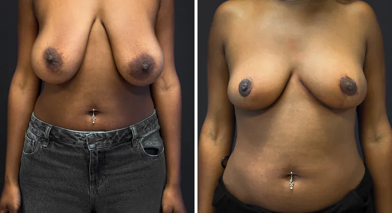 Before and after breast reduction: patient's breasts from the front