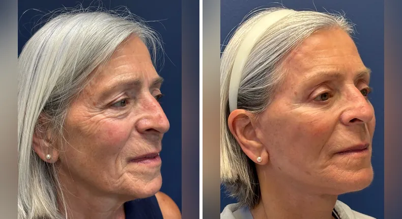 Before and after brow lift: patient's face from the right side, with eyelid surgery, Face360, facelift, facial fat grafting and neck lift