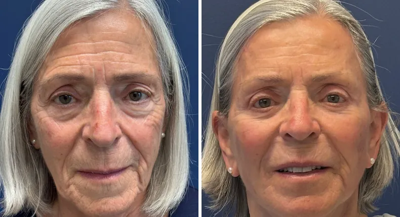 Before and after brow lift: patient's face, with eyelid surgery, Face360, facelift, facial fat grafting and neck lift