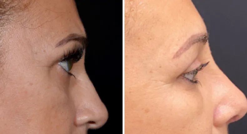 Before and after brow lift: patient's face in right profile, with eyelid surgery