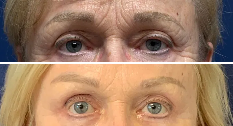 Before and after brow lift: patient's face, with eyelid surgery