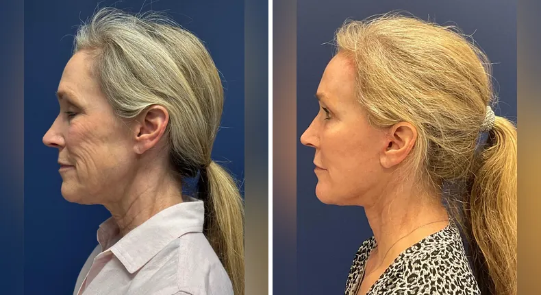 Before and after brow lift: patient's face from the left side, with Face360, facelift, facial fat grafting and neck lift