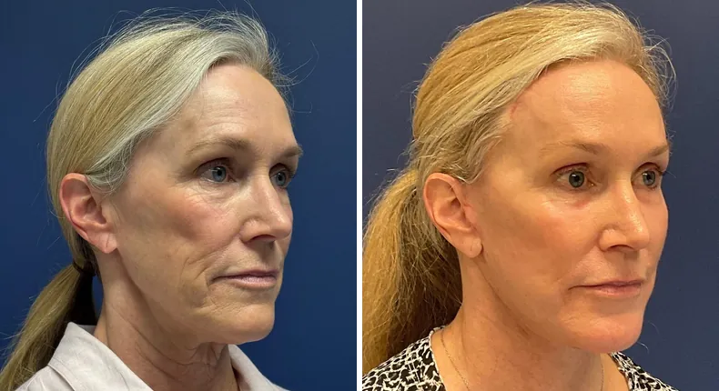 Before and after brow lift: patient's face from the right side, with Face360, facelift, facial fat grafting and neck lift