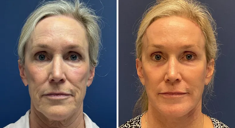 Before and after brow lift: patient's face, with Face360, facelift, facial fat grafting and neck lift