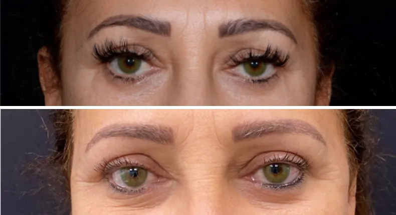 Before and after brow lift: patient's face from the front, with eyelid surgery