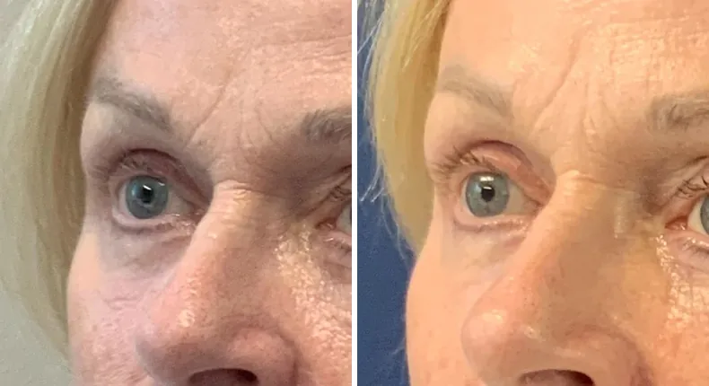 Before and after brow lift: patient's face from the left side, with eyelid surgery