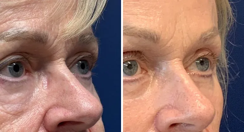 Before and after brow lift: patient's face from the right side, with eyelid surgery