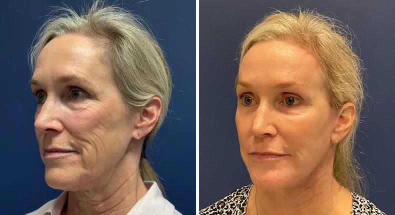 Before and after brow lift: patient's face from the left side, with Face360, facelift, facial fat grafting and neck lift