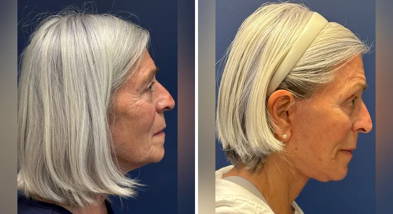 Before and after brow lift: patient's face from the right side, with eyelid surgery, Face360, facelift, facial fat grafting and neck lift