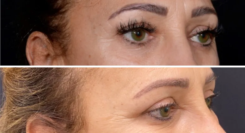 Before and after brow lift: patient's face at a right angle, with eyelid surgery