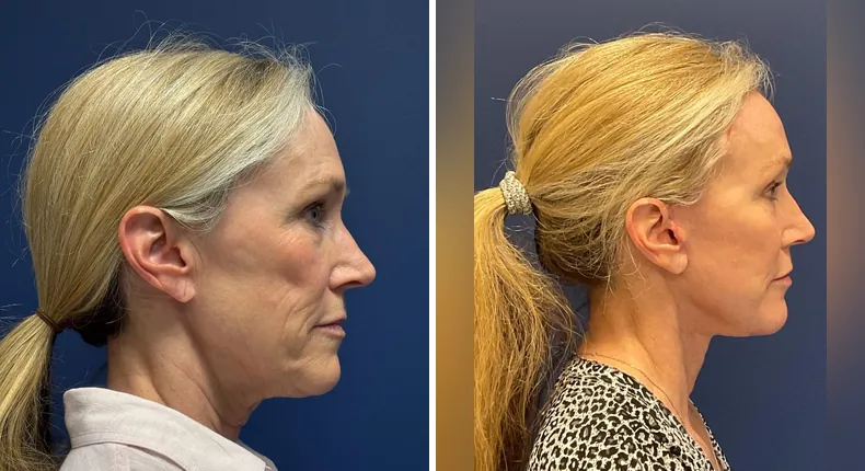 Before and after brow lift: patient's face from the right side, with Face360, facelift, facial fat grafting and neck lift
