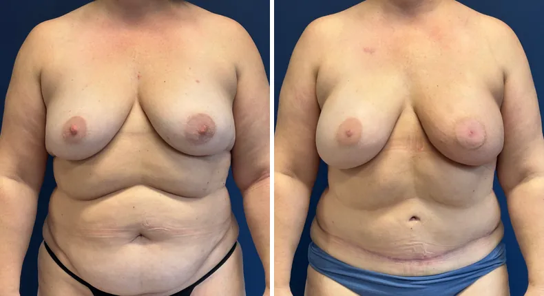 Before and after DIEP Flap: patient's breasts