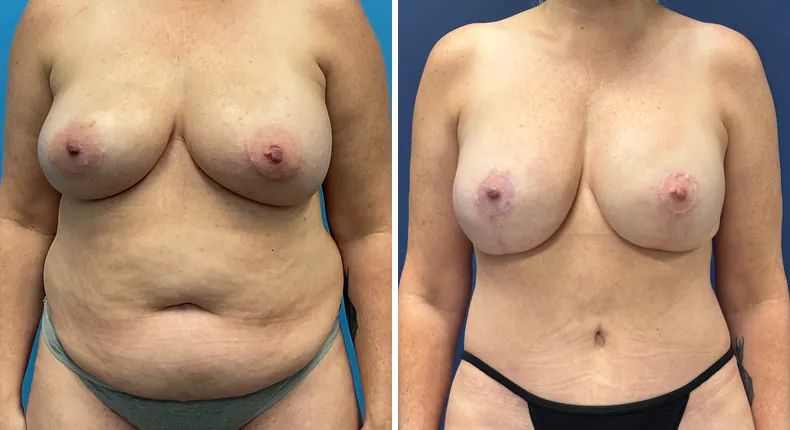 Before and after DIEP Flap: patient's breasts