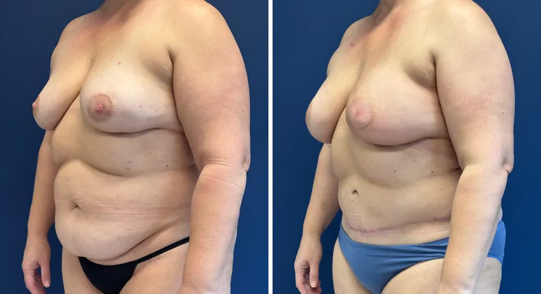 Before and after DIEP Flap: patient's breasts at a left angle