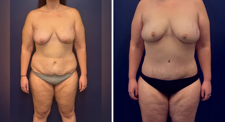 Before and after DIEP Flap: patient's breasts