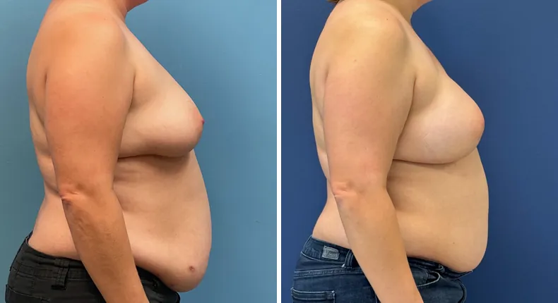 Before and after DIEP Flap: patient's breasts from the right side