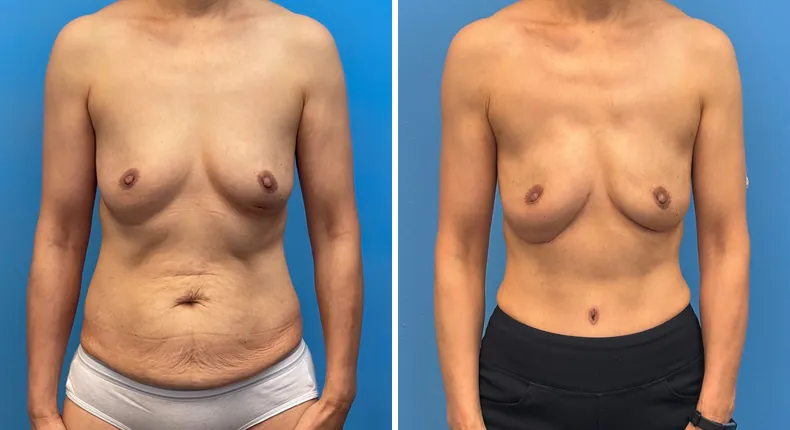 Before and after DIEP Flap: patient's breasts