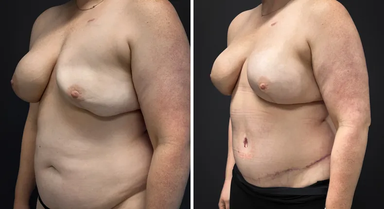 Before and after DIEP Flap: patient's breasts from the left side