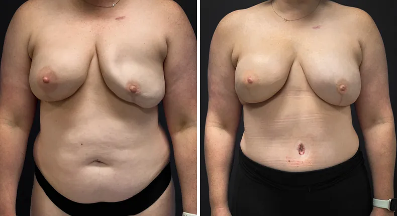 Before and after DIEP Flap: patient's breasts from the front