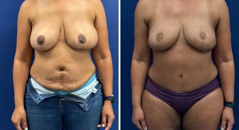 Before and after DIEP Flap: patient's breasts