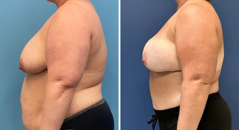 Before and after DIEP Flap: patient's breasts from the left side