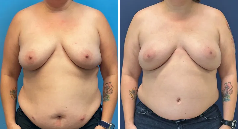 Before and after DIEP Flap: patient's breasts from the front