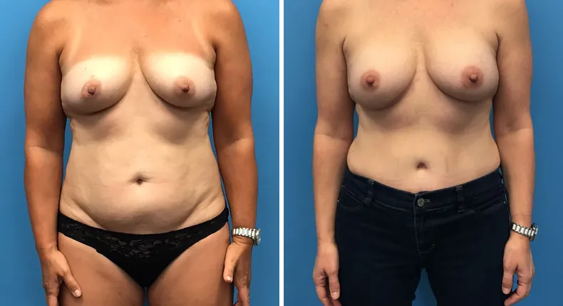 Before and after DIEP Flap: patient's breasts from the front