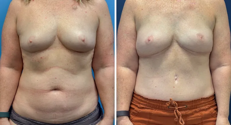 Before and after DIEP Flap: patient's breasts