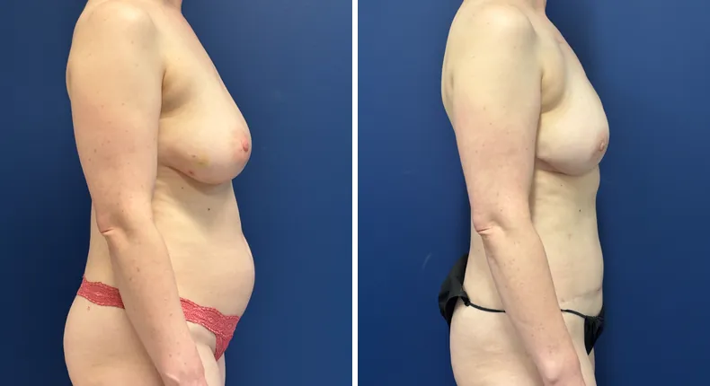 Before and after DIEP Flap: patient's breasts from the right side
