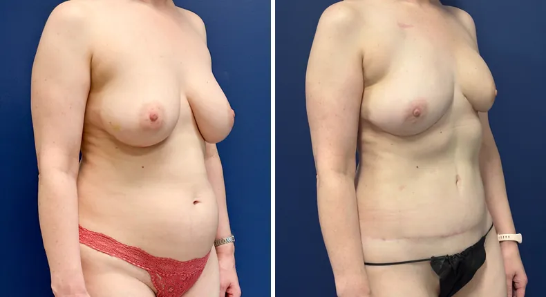 Before and after DIEP Flap: patient's breasts from the right side