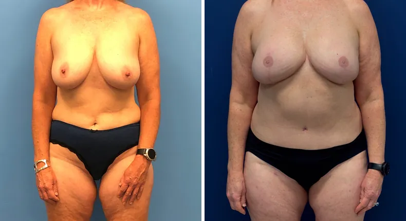 Before and after DIEP Flap: patient's breasts