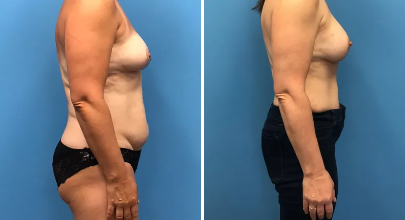 Before and after DIEP Flap: patient's breasts in right profile