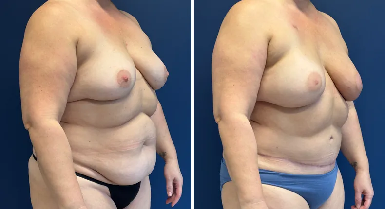 Before and after DIEP Flap: patient's breasts at a right angle